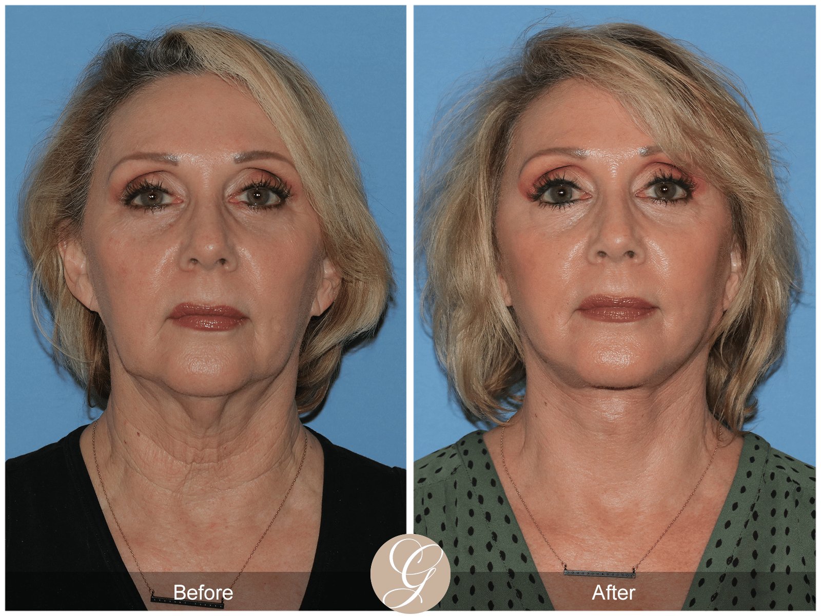 Deep Plane Facelift & Deep Plane Necklift Case 3 Image
