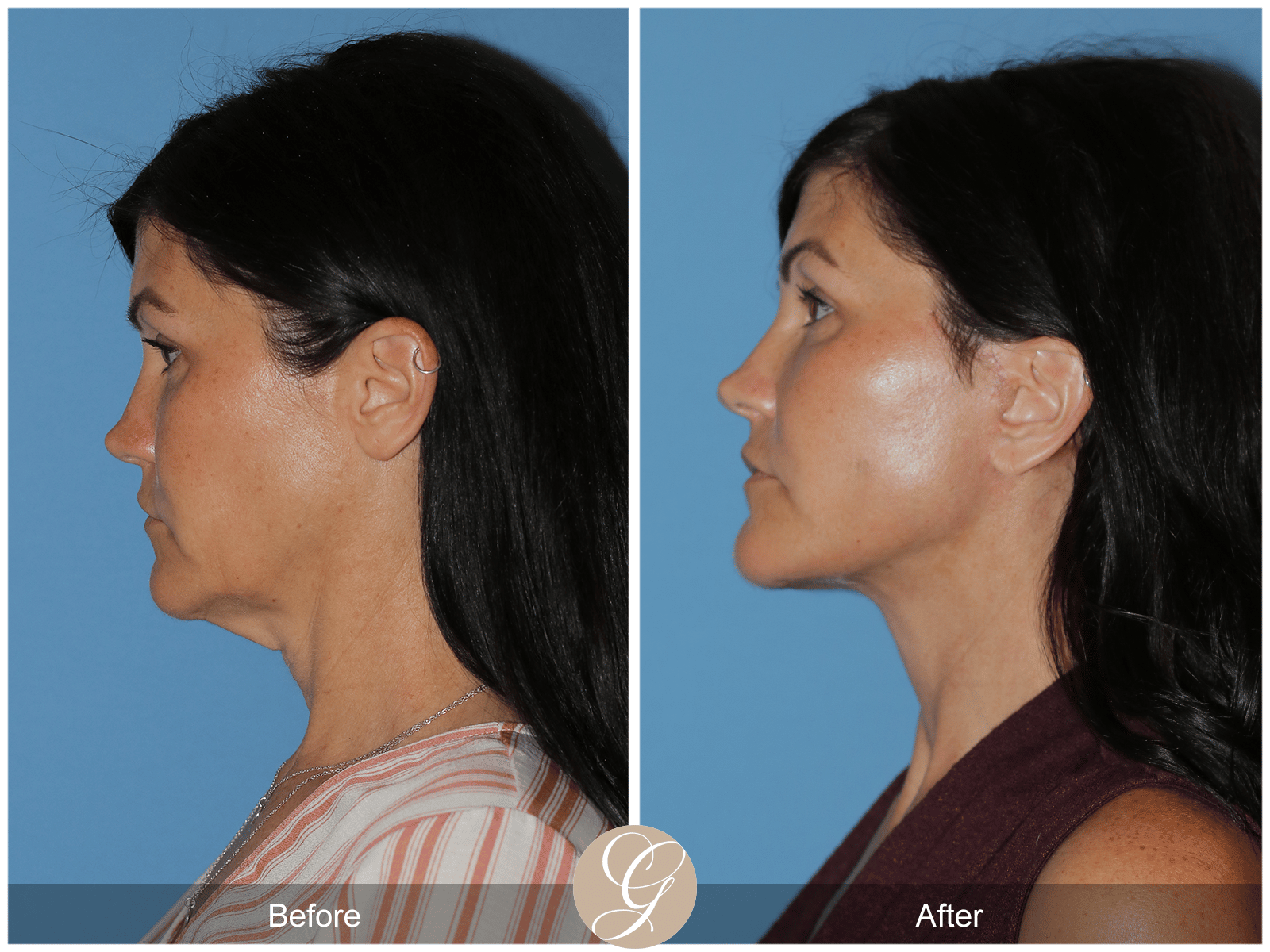 Lower Facelift and Deep Plane Necklift Case 1 Image