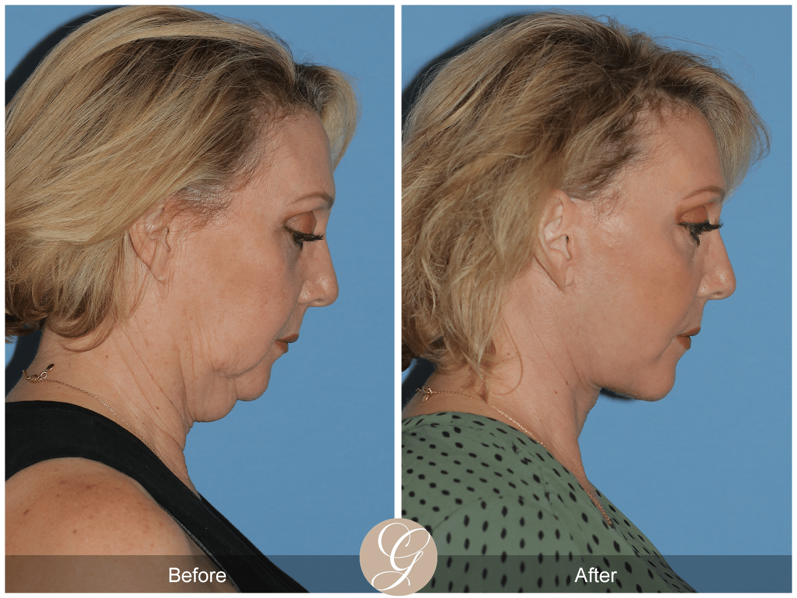 Deep Plane Facelift & Deep Plane Necklift Case 3 Image