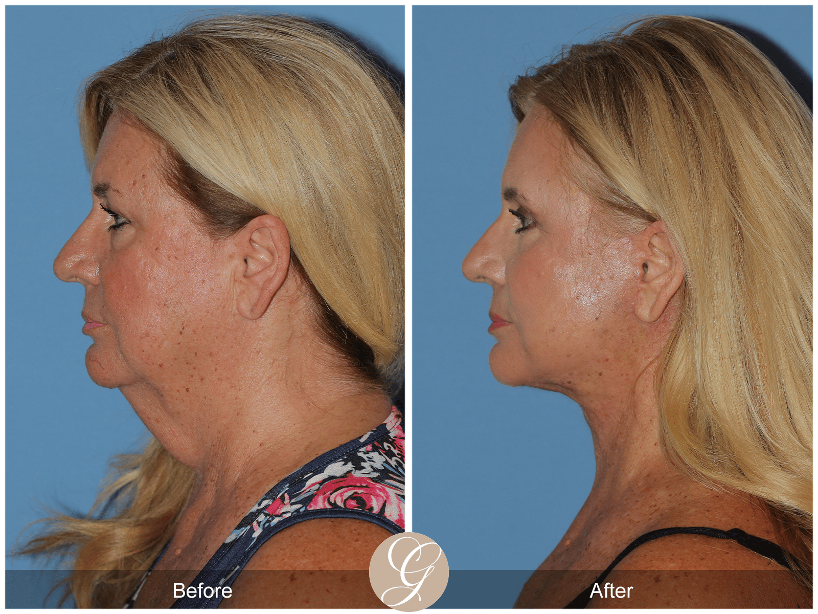 Deep Plane Facelift & Deep Plane Necklift Case 2 Image