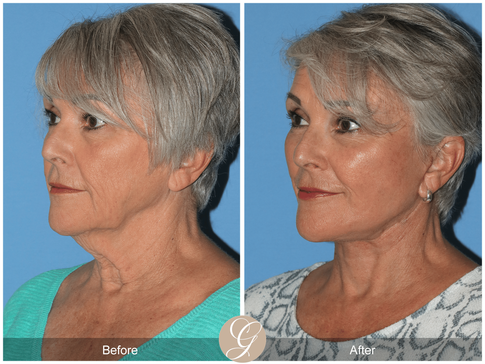 Deep Plane Facelift and Deep Plane NeckLift Case 1
