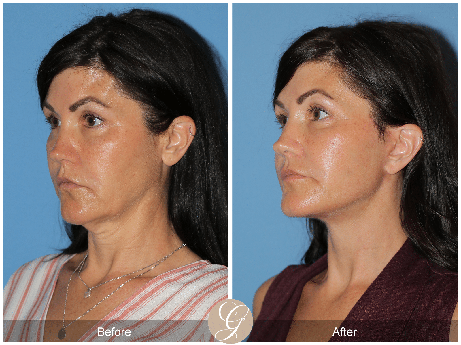 Lower Facelift and Deep Plane Necklift Case 1 Image