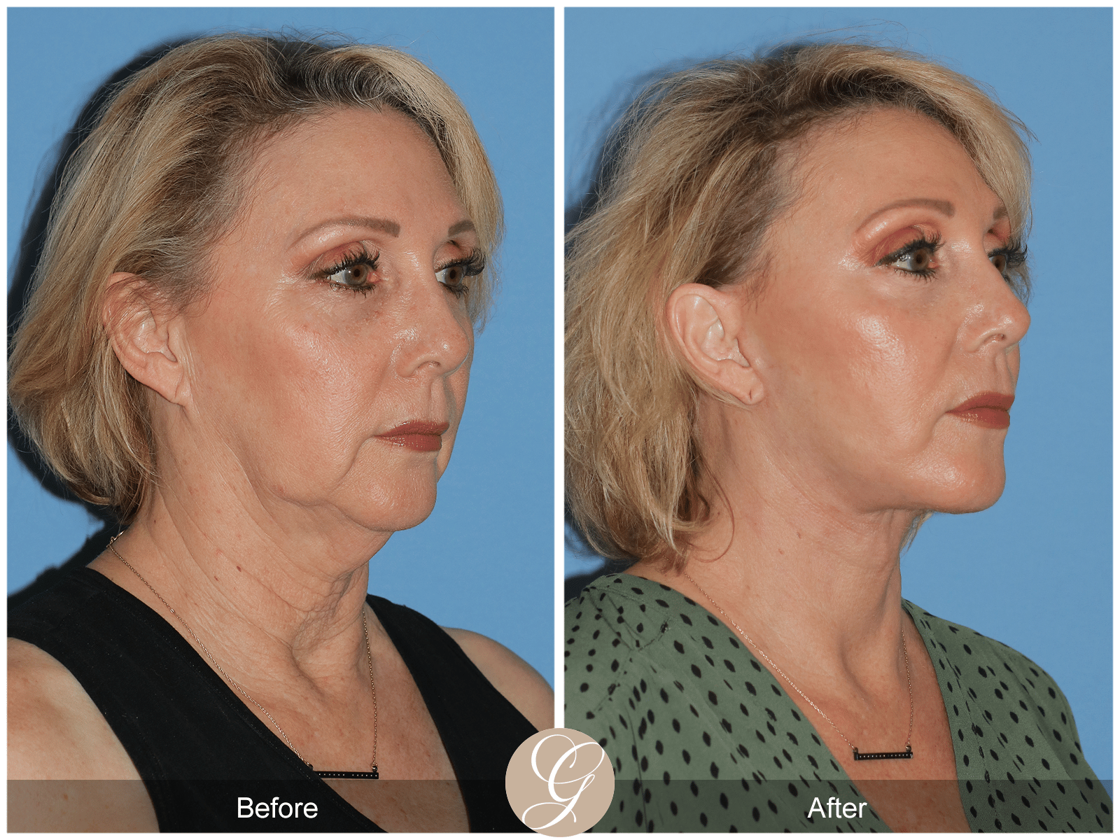 Deep Plane Facelift & Deep Plane Necklift Case 3 Image