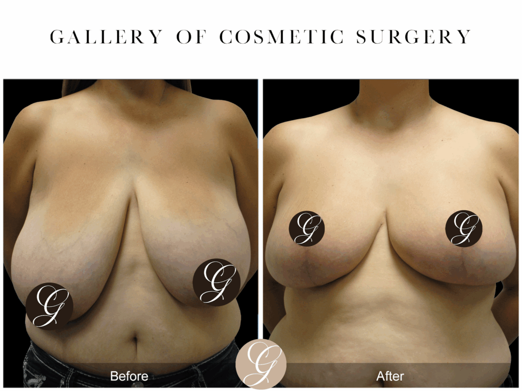 Breast Reduction