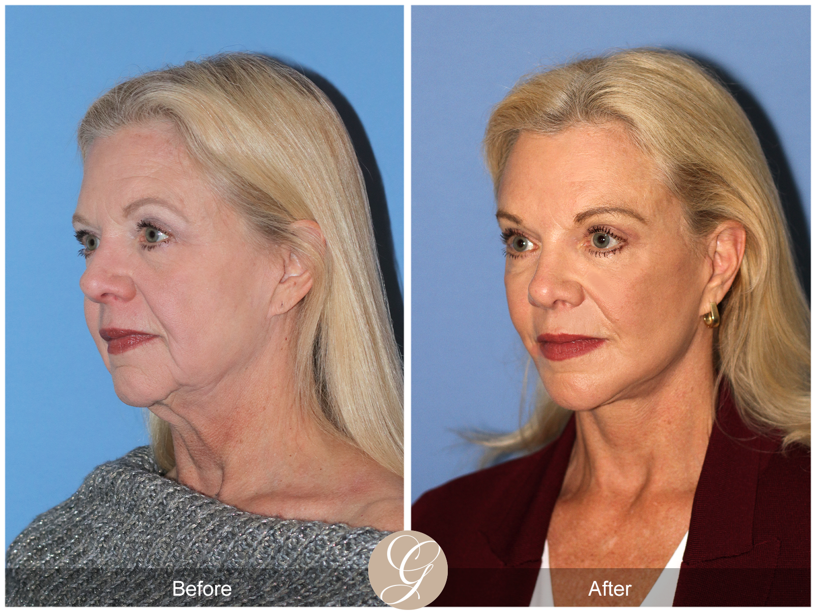 Deep Plane Facelift and Neck Lift – Case 23 Image