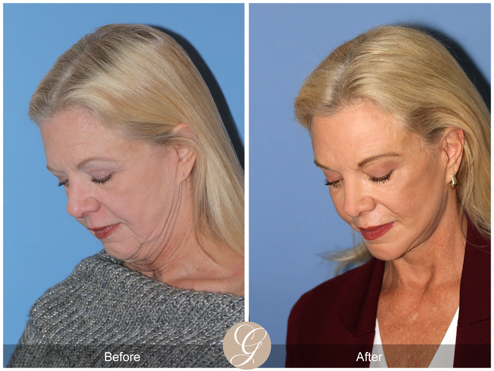 Deep Plane Facelift and Neck Lift – Case 23 Image