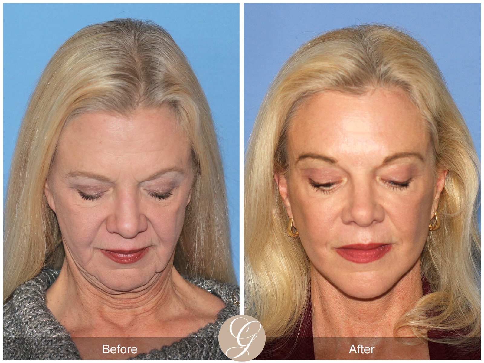 Deep Plane Facelift and Neck Lift – Case 23 Image