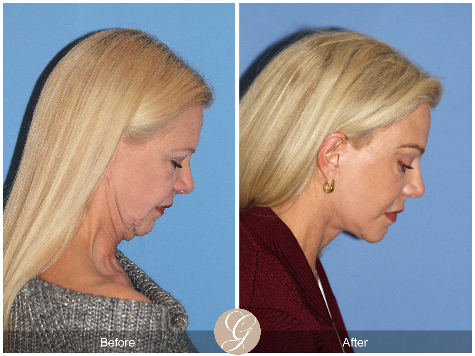 Deep Plane Facelift and Neck Lift – Case 23 Image