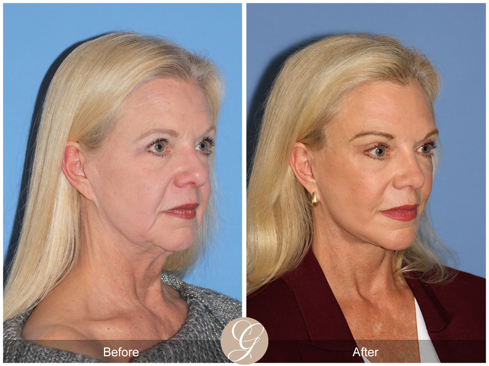 Deep Plane Facelift and Neck Lift – Case 23 Image