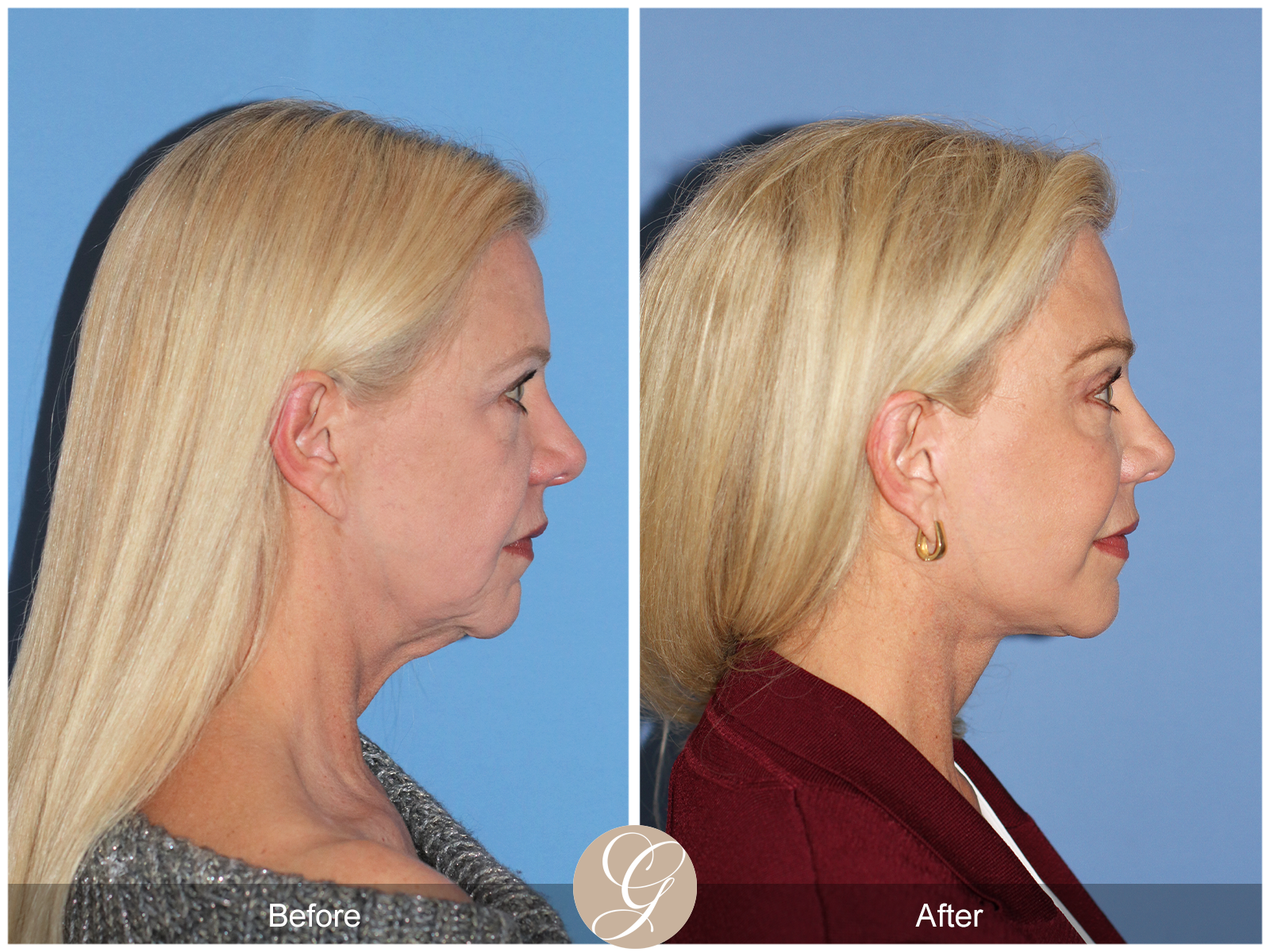 Deep Plane Facelift and Neck Lift – Case 23 Image