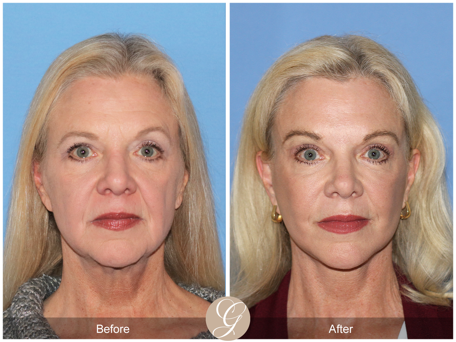 Deep Plane Facelift and Neck Lift – Case 23 Image