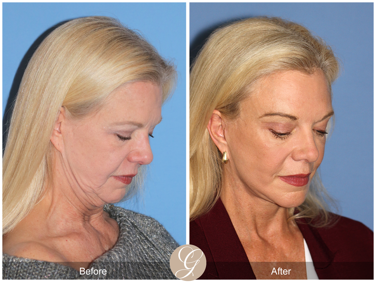 Deep Plane Facelift and Neck Lift – Case 23 Image