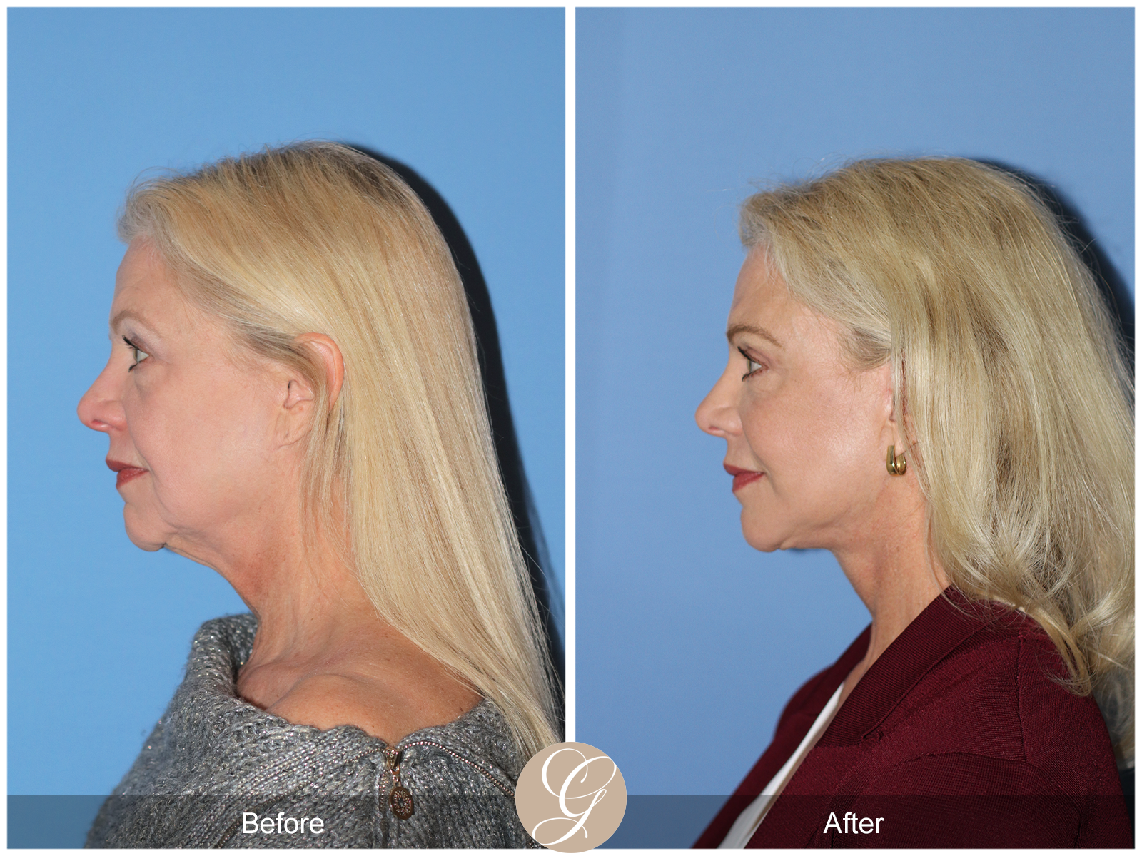 Deep Plane Facelift and Neck Lift – Case 23 Image