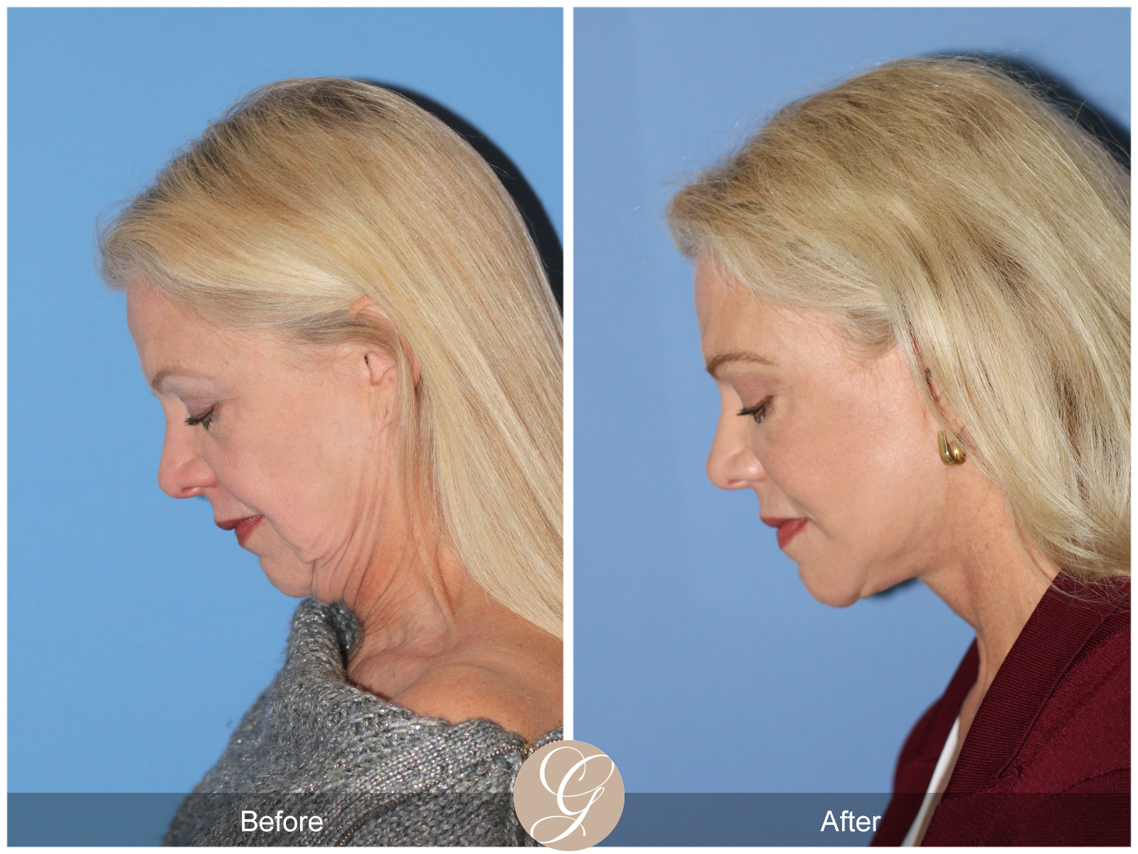 Deep Plane Facelift and Neck Lift – Case 23 Image