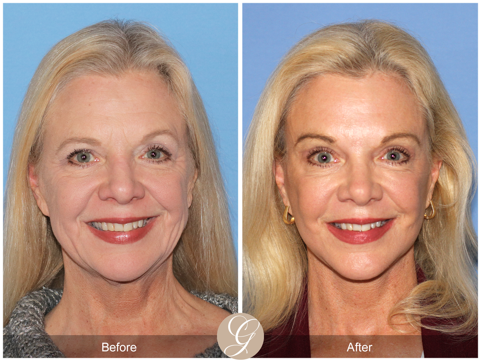 Deep Plane Facelift and Neck Lift – Case 23 Image