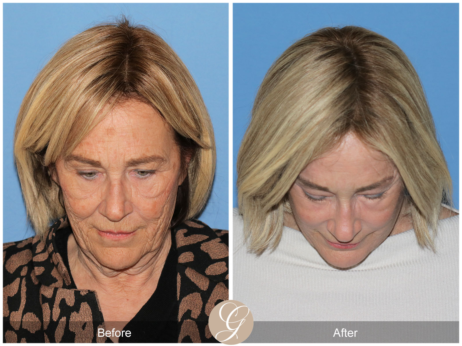 Deep Plane Facelift and Neck Lift – Case 24 Image