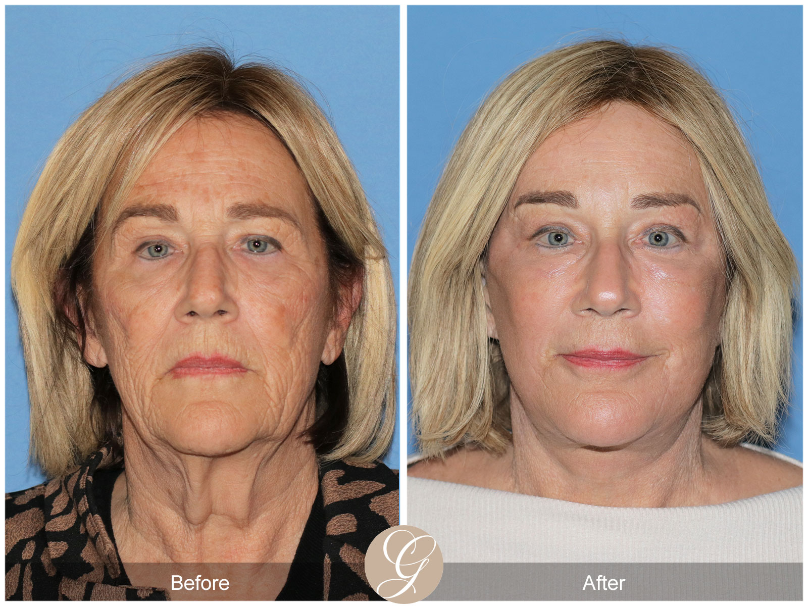 Deep Plane Facelift and Neck Lift – Case 24 Image