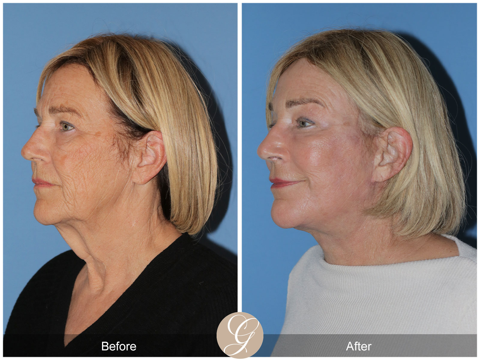 Deep Plane Facelift and Neck Lift – Case 24 Image