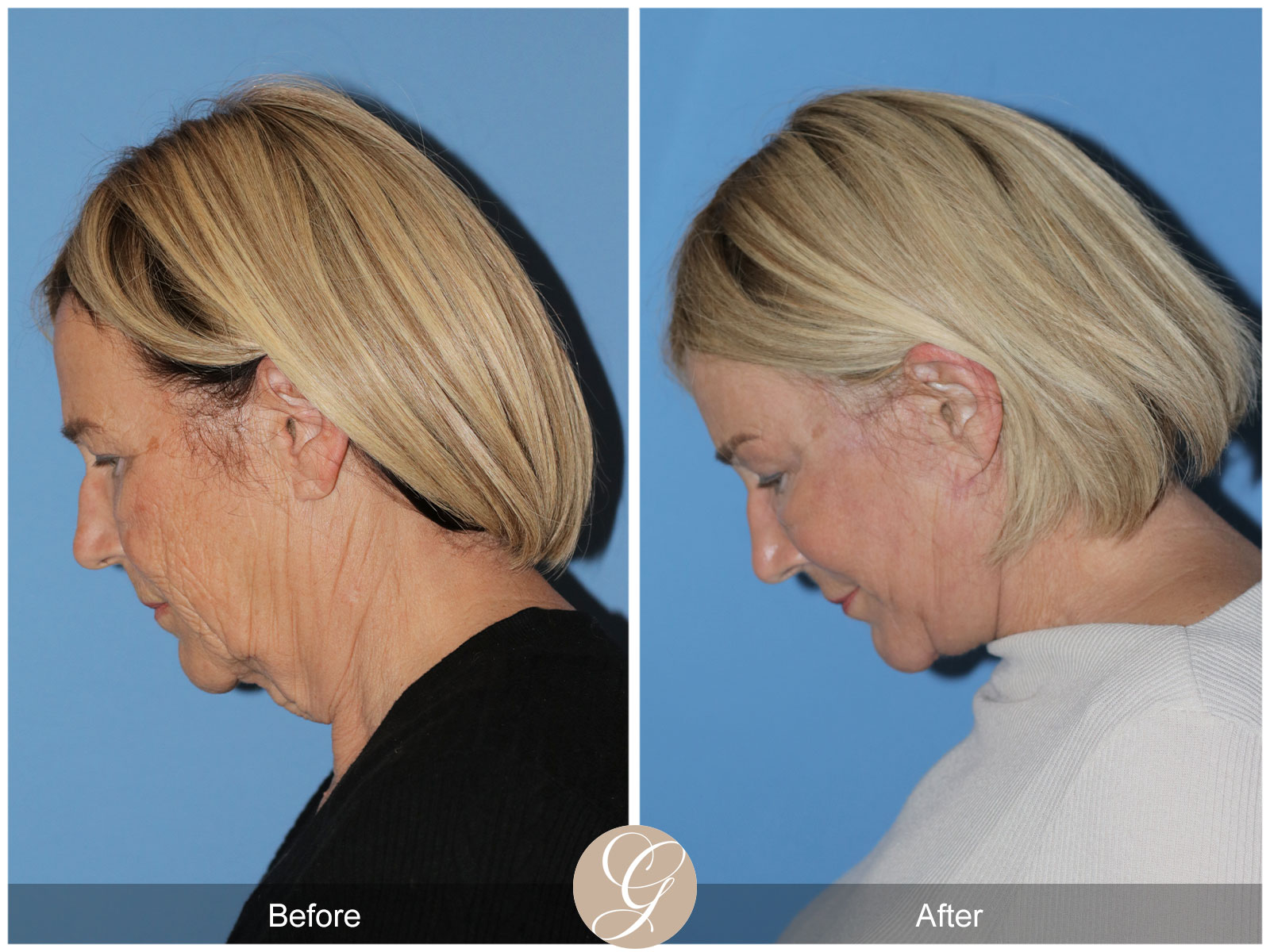 Deep Plane Facelift and Neck Lift – Case 24 Image