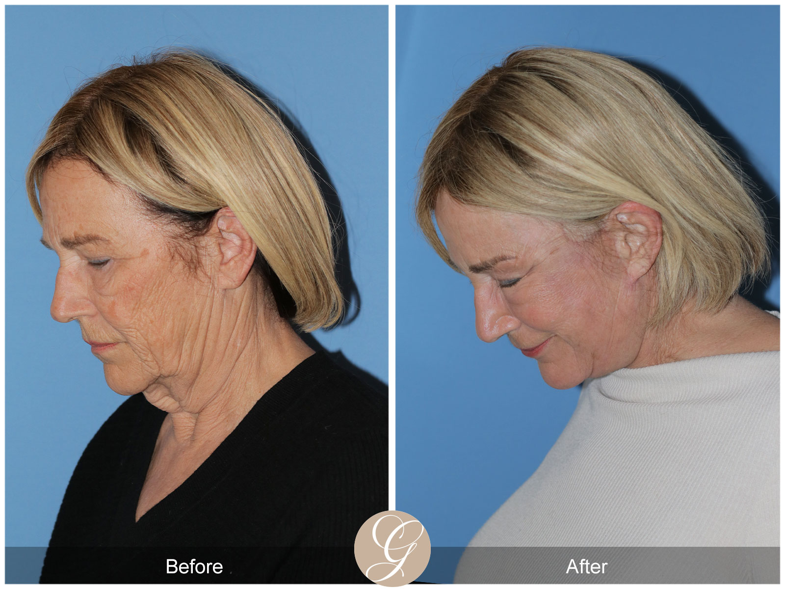 Deep Plane Facelift and Neck Lift – Case 24 Image