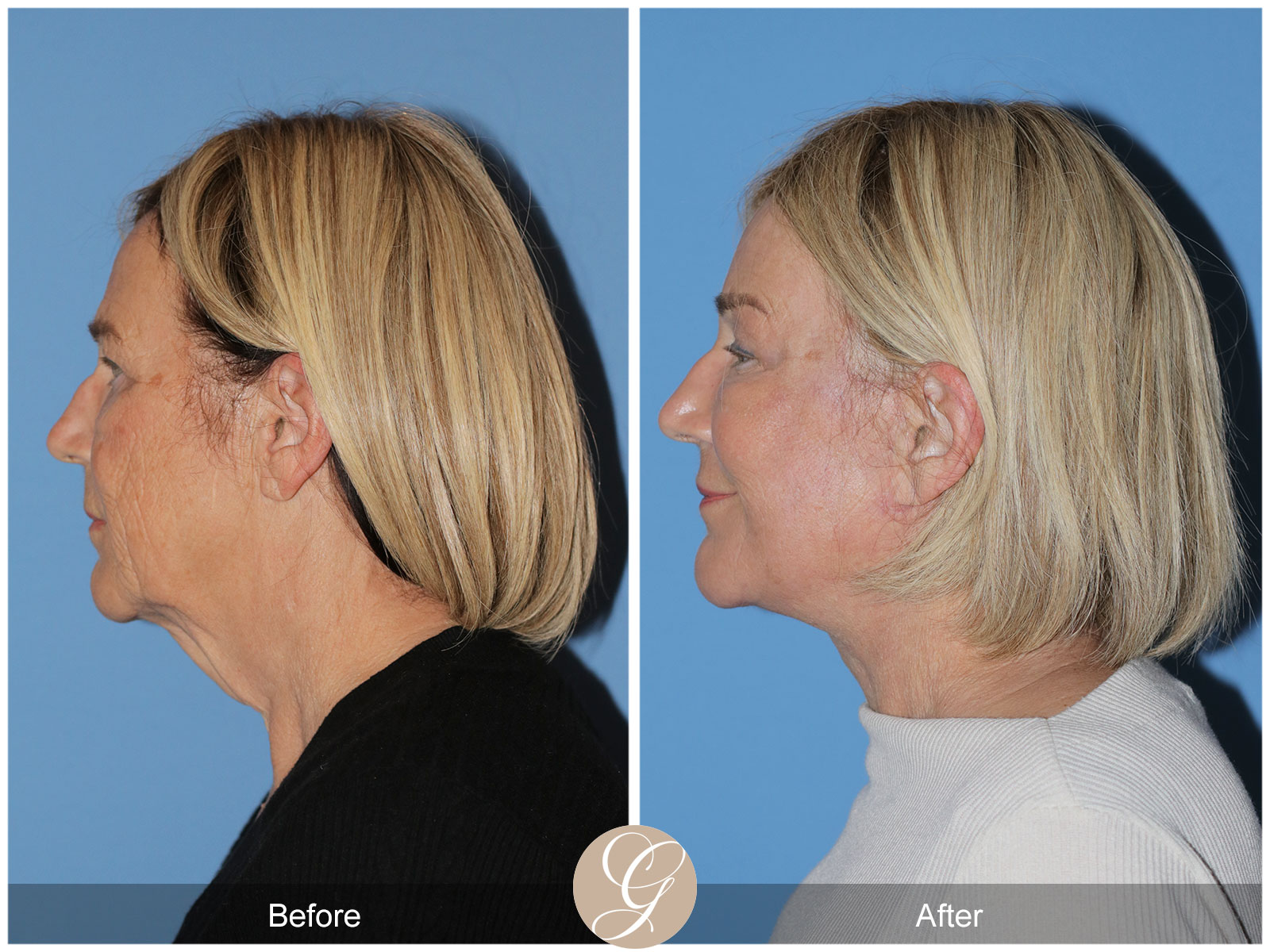 Deep Plane Facelift and Neck Lift – Case 24 Image