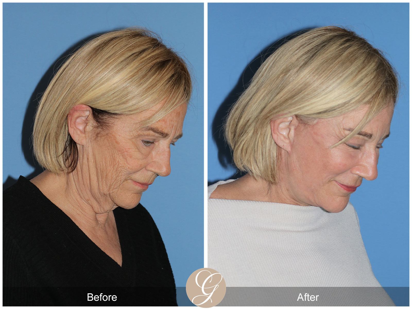Deep Plane Facelift and Neck Lift – Case 24 Image