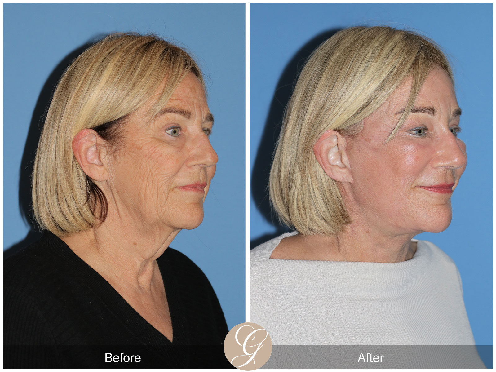 Deep Plane Facelift and Neck Lift – Case 24 Image