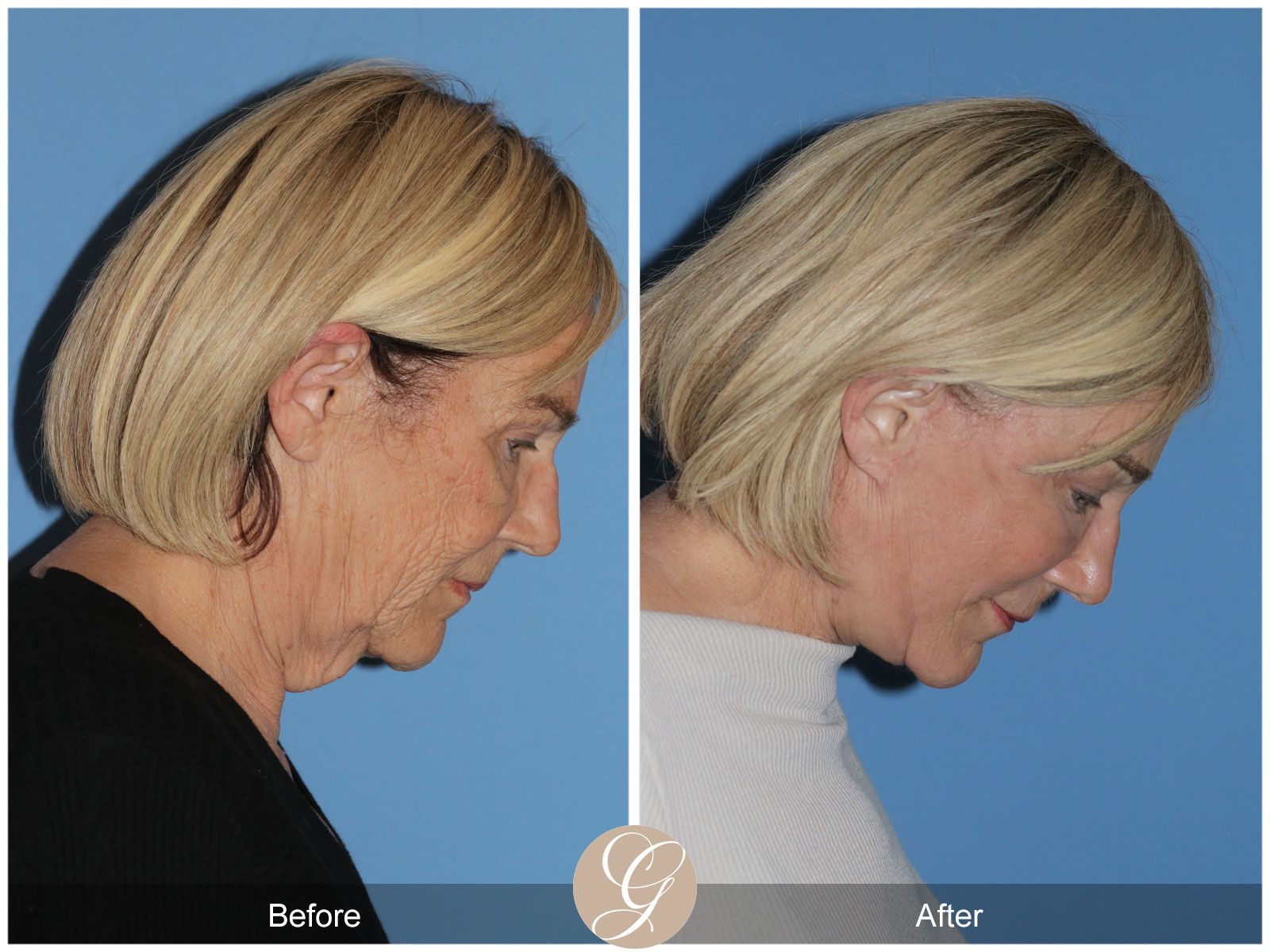 Deep Plane Facelift and Neck Lift – Case 24 Image