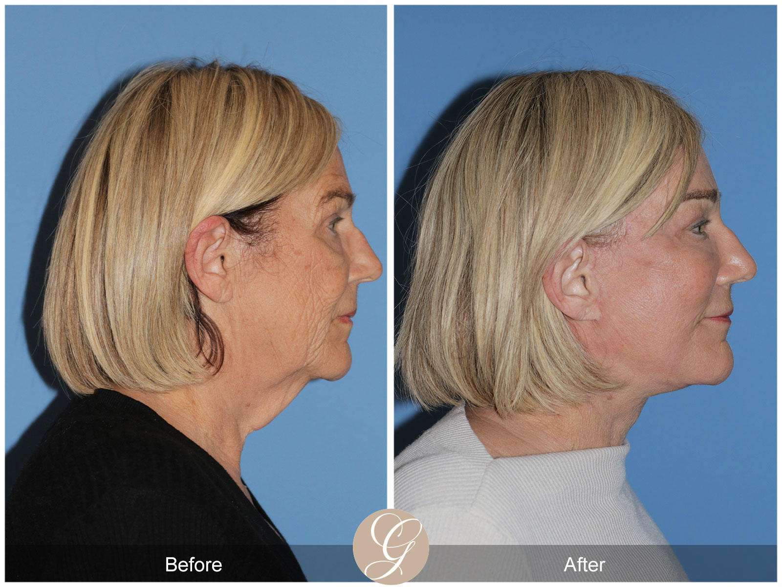 Deep Plane Facelift and Neck Lift – Case 24 Image
