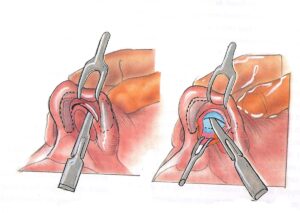 Orange County Closed Rhinoplasty