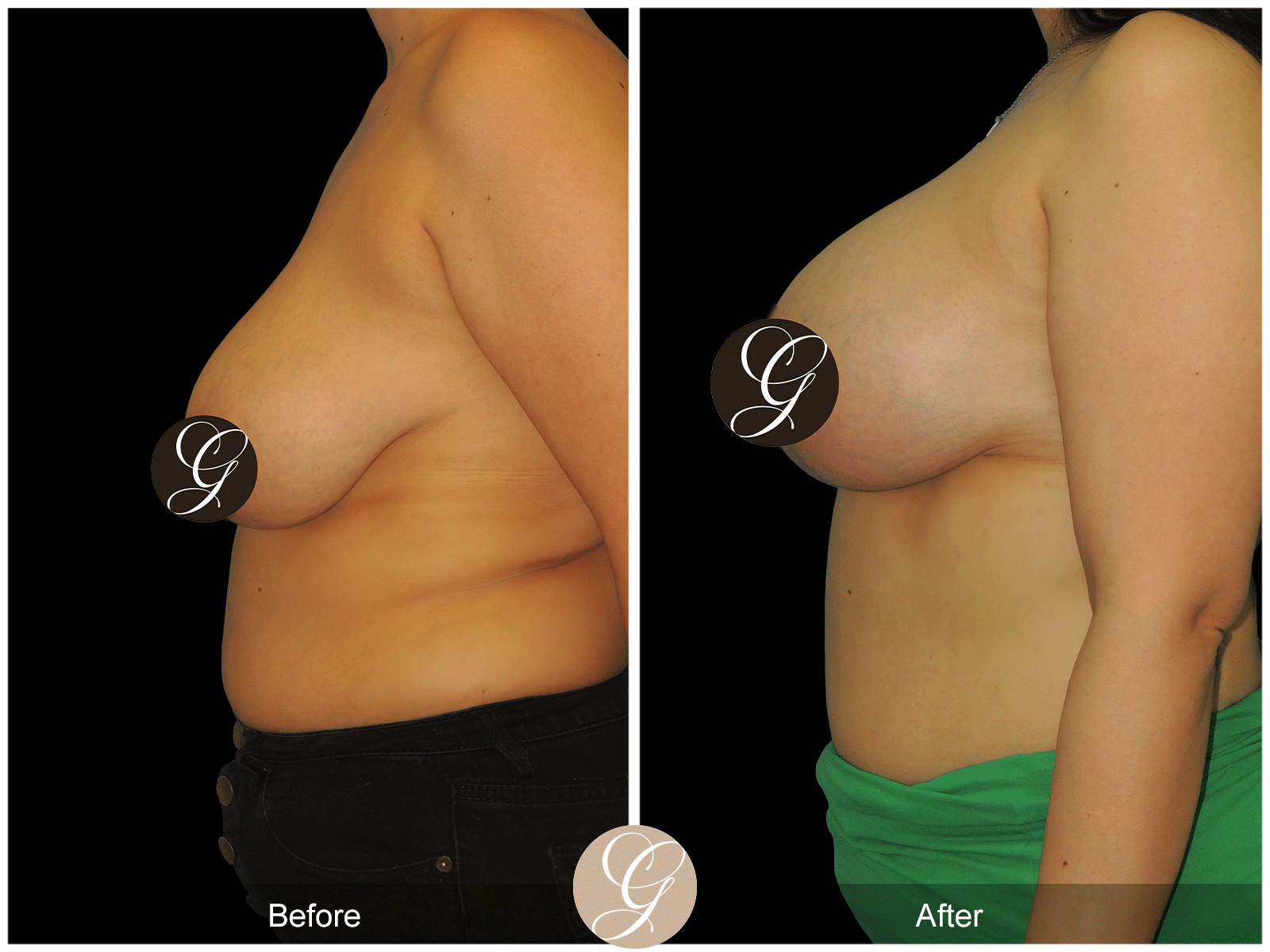 Breast Auto Augmentation Image