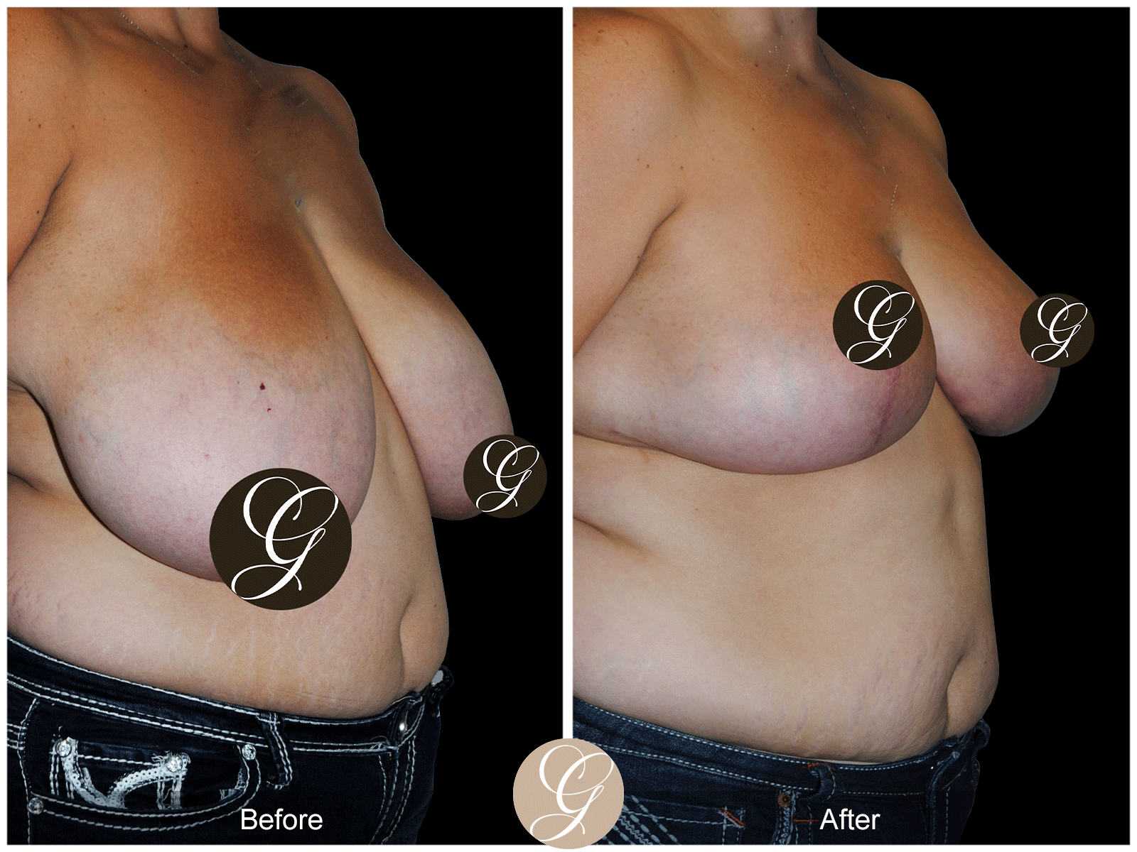 Breast Reduction Image