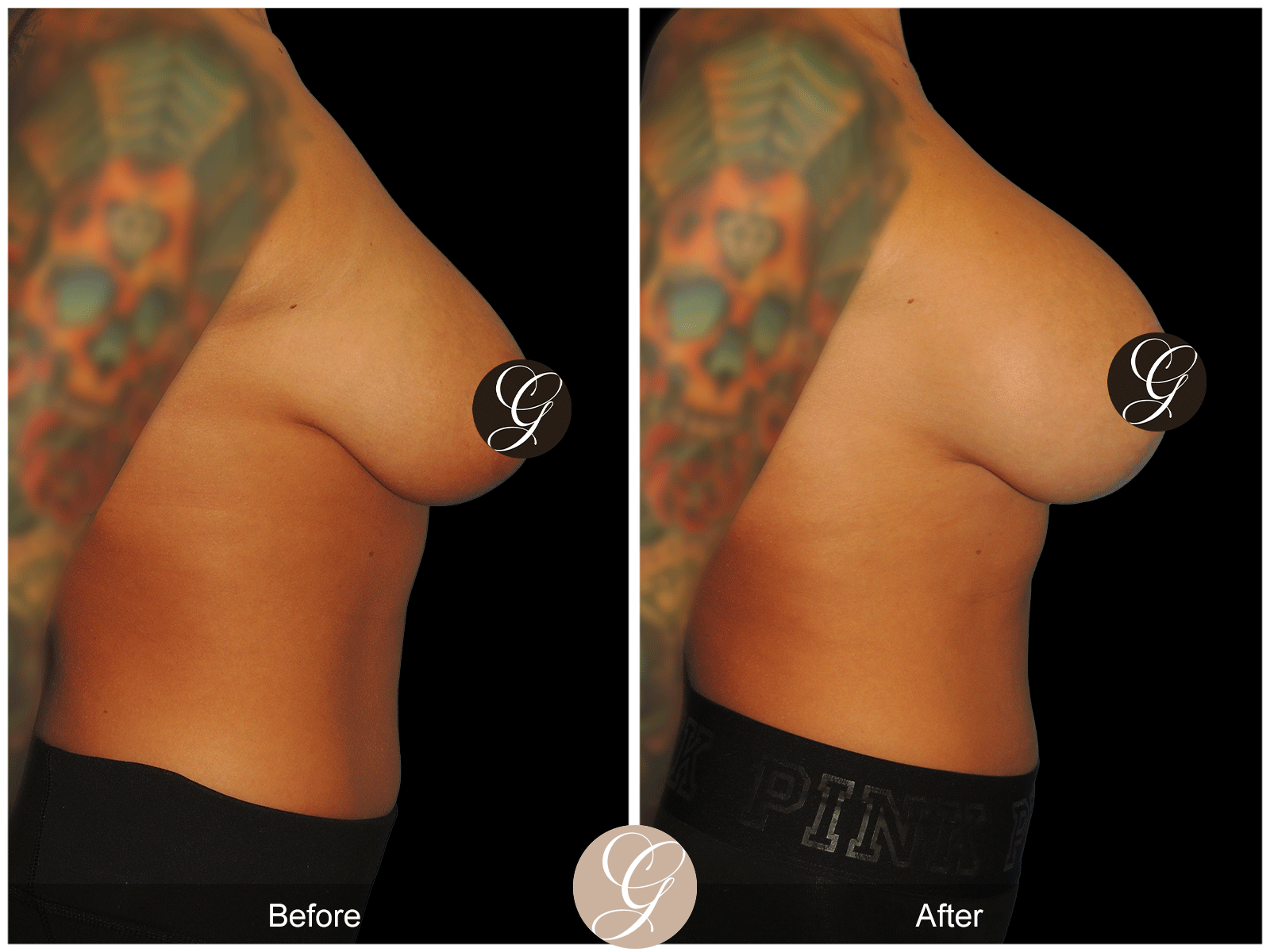 Breast Augmentation with Lift & Mesh Image