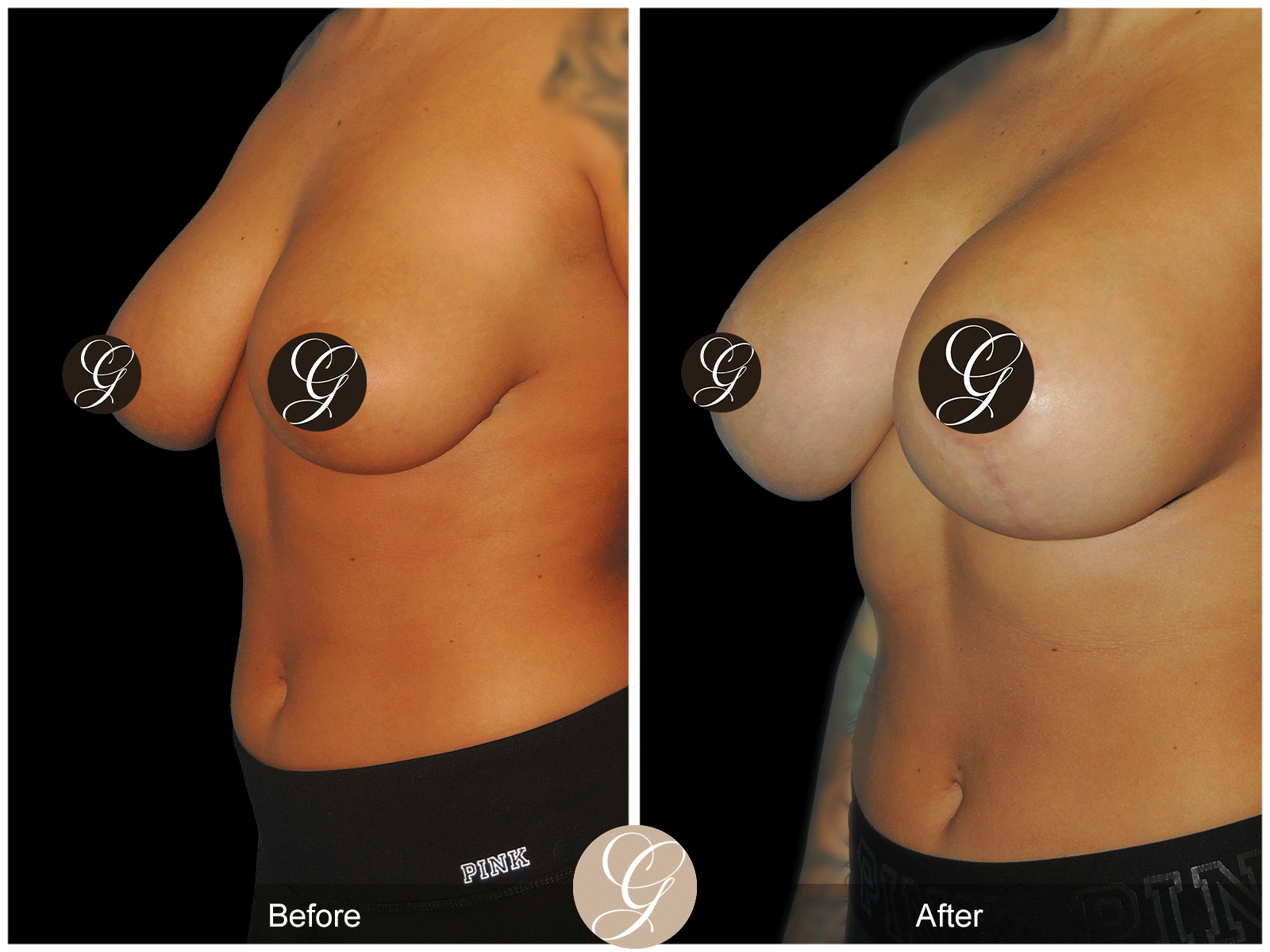 Breast Augmentation with Lift & Mesh Image