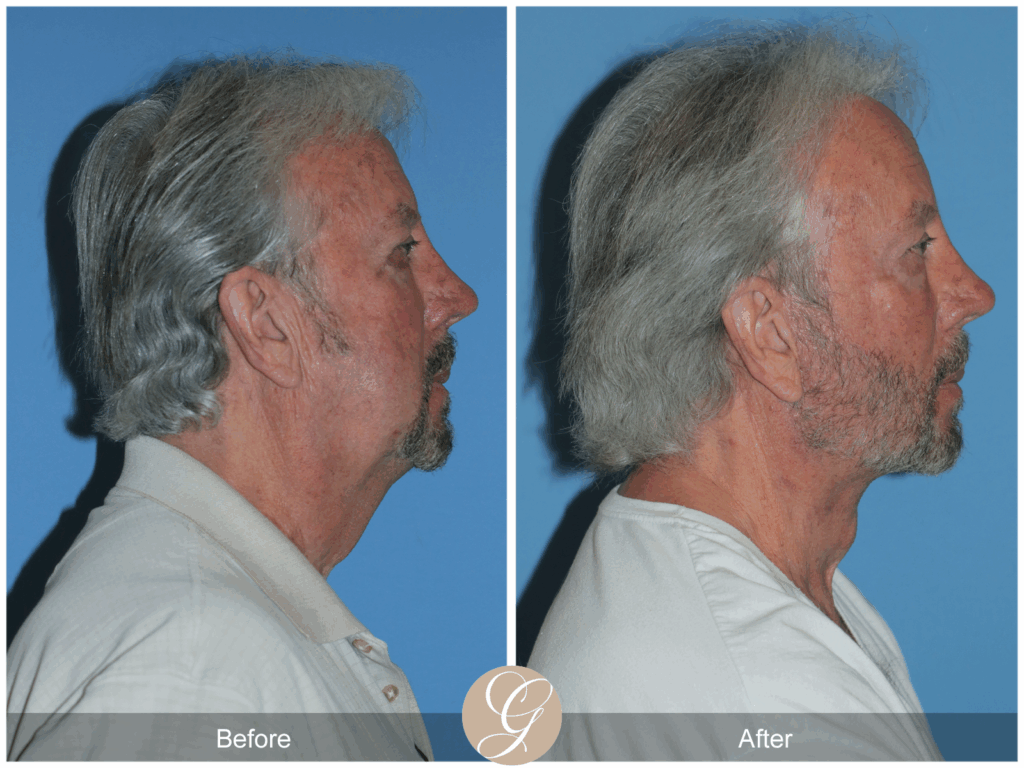 Deep Plane Neck Lift for Men: Achieve a Redefined Jawline Contouring in Newport Beach, CA