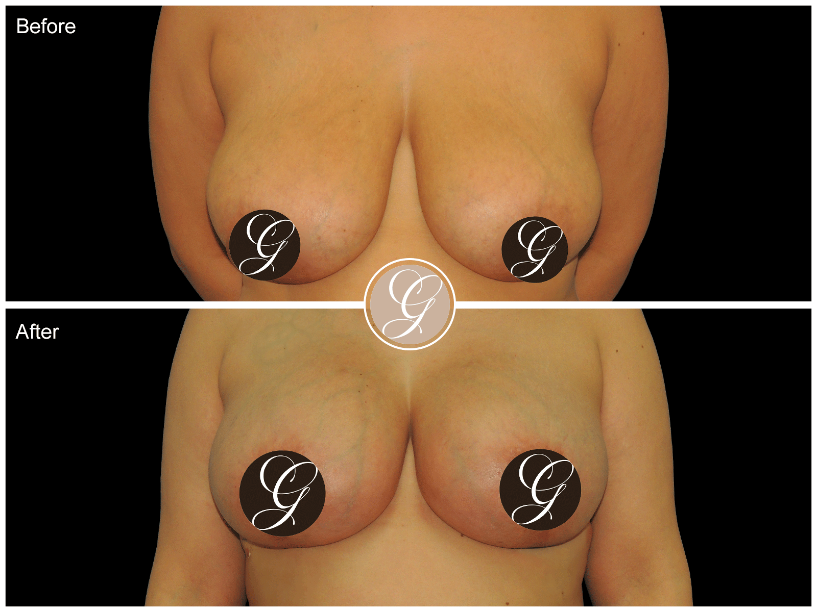 Breast Auto Augmentation Image