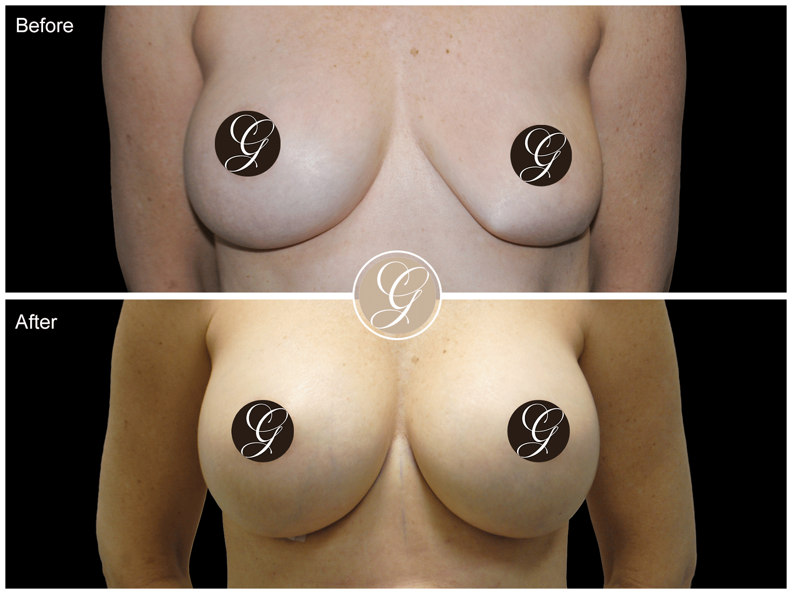 Breast Explant & Augmentation Image