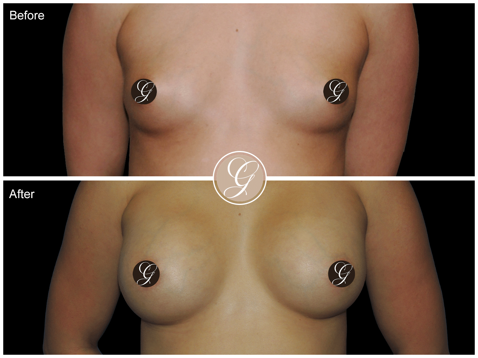 Breast Augmentation Pt 24 Image