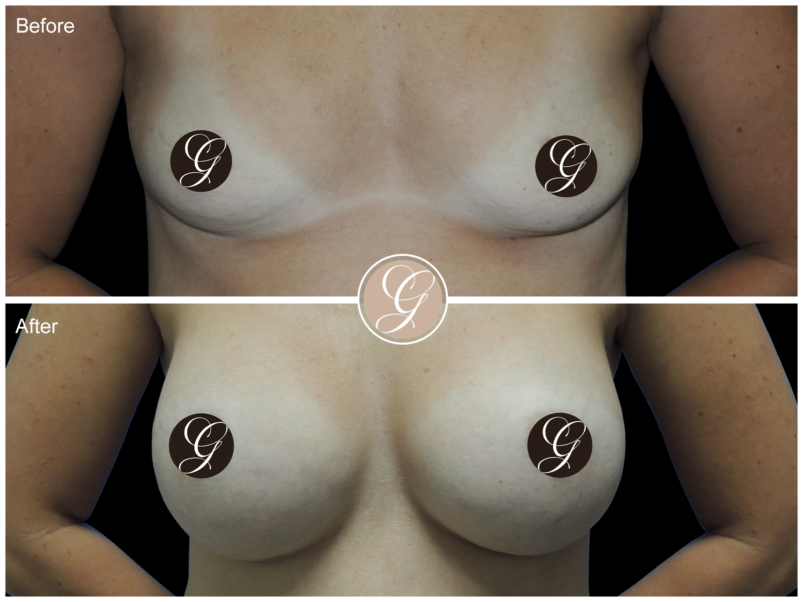 Breast Augmentation Pt 25 Image