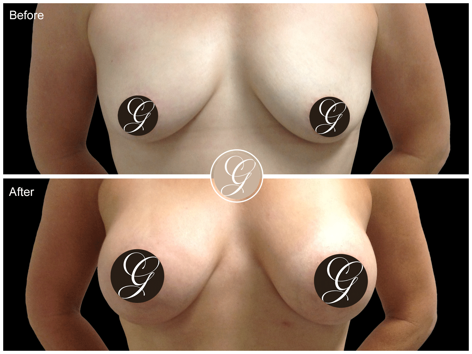 Breast Augmentation Pt 26 Image