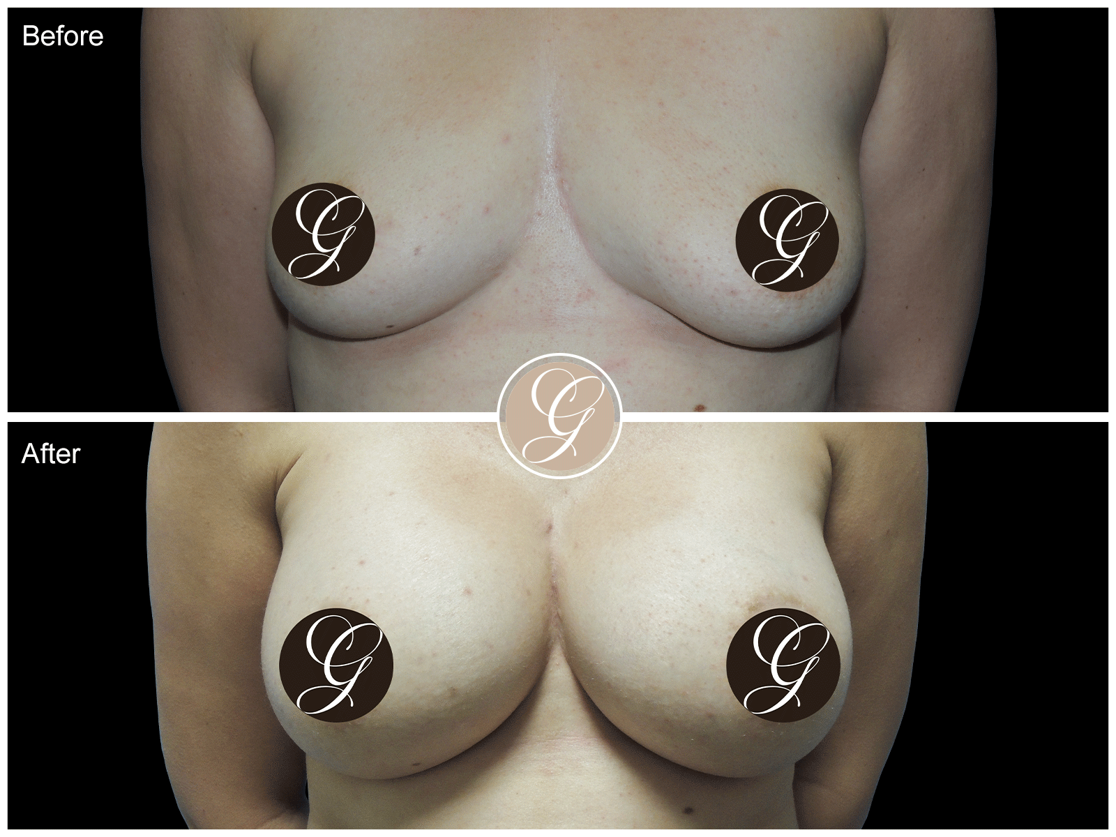 Breast Augmentation Pt 27 Image