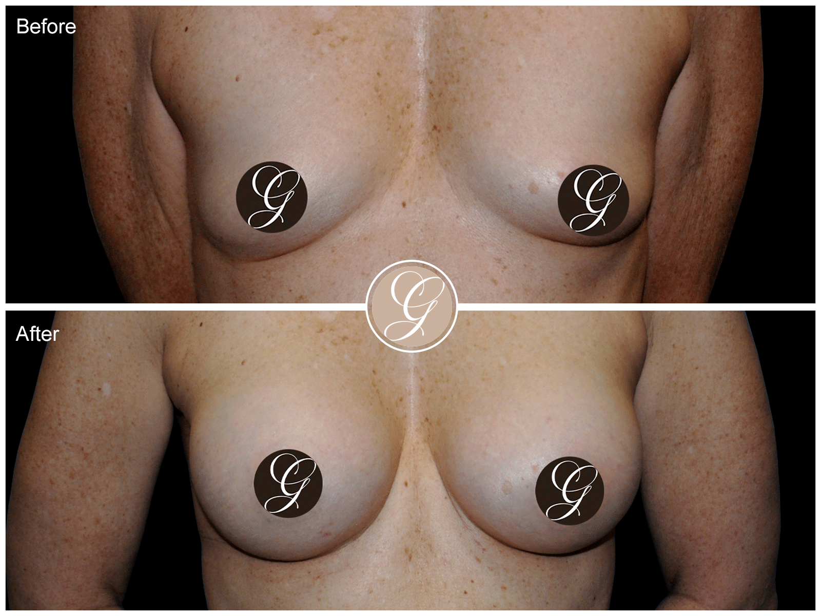 Breast Augmentation Pt 28 Image