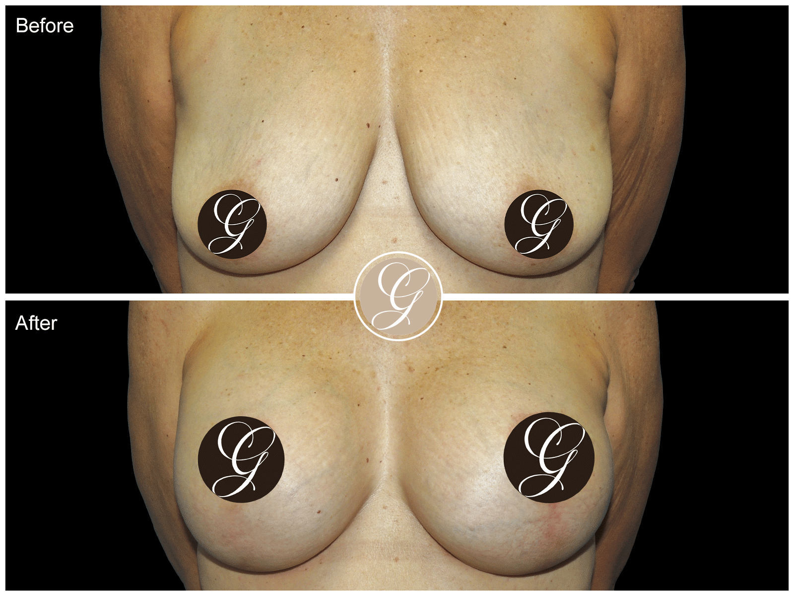 Breast Augmentation Pt 29 Image