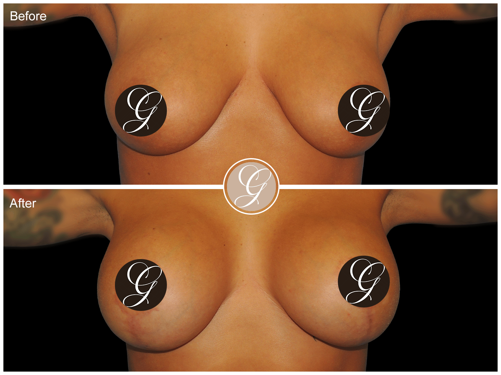 Breast Augmentation with Lift & Mesh Image