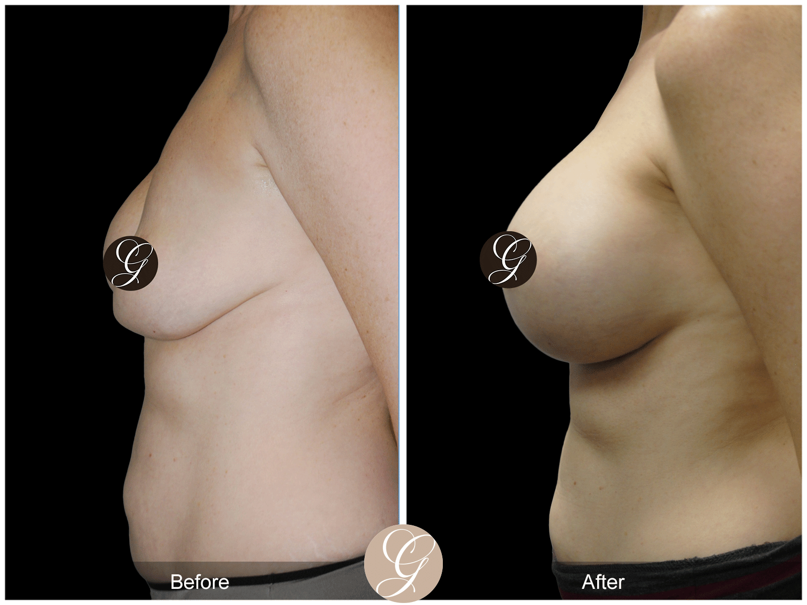 Breast Explant & Augmentation Image