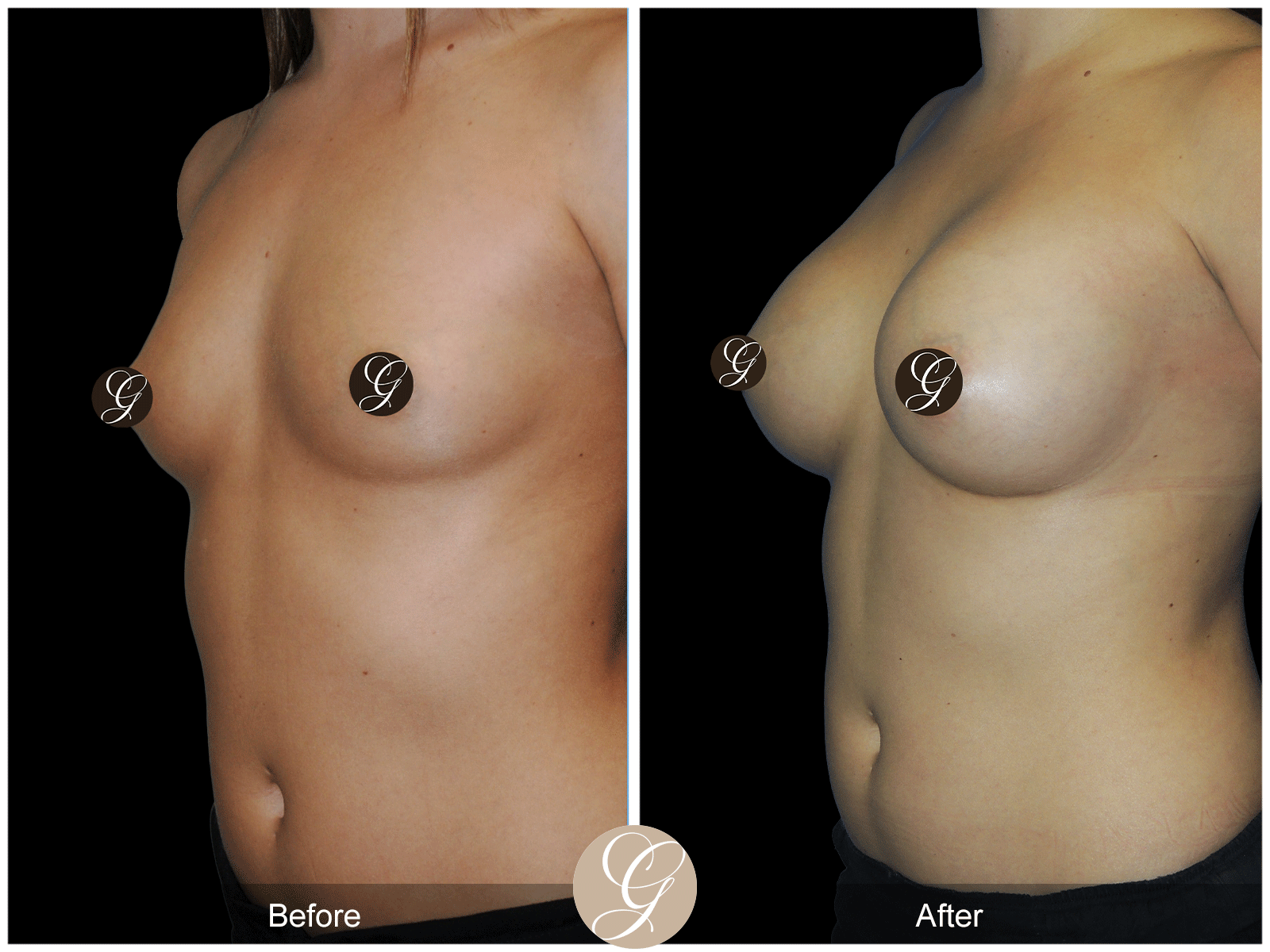 Breast Augmentation Pt 24 Image