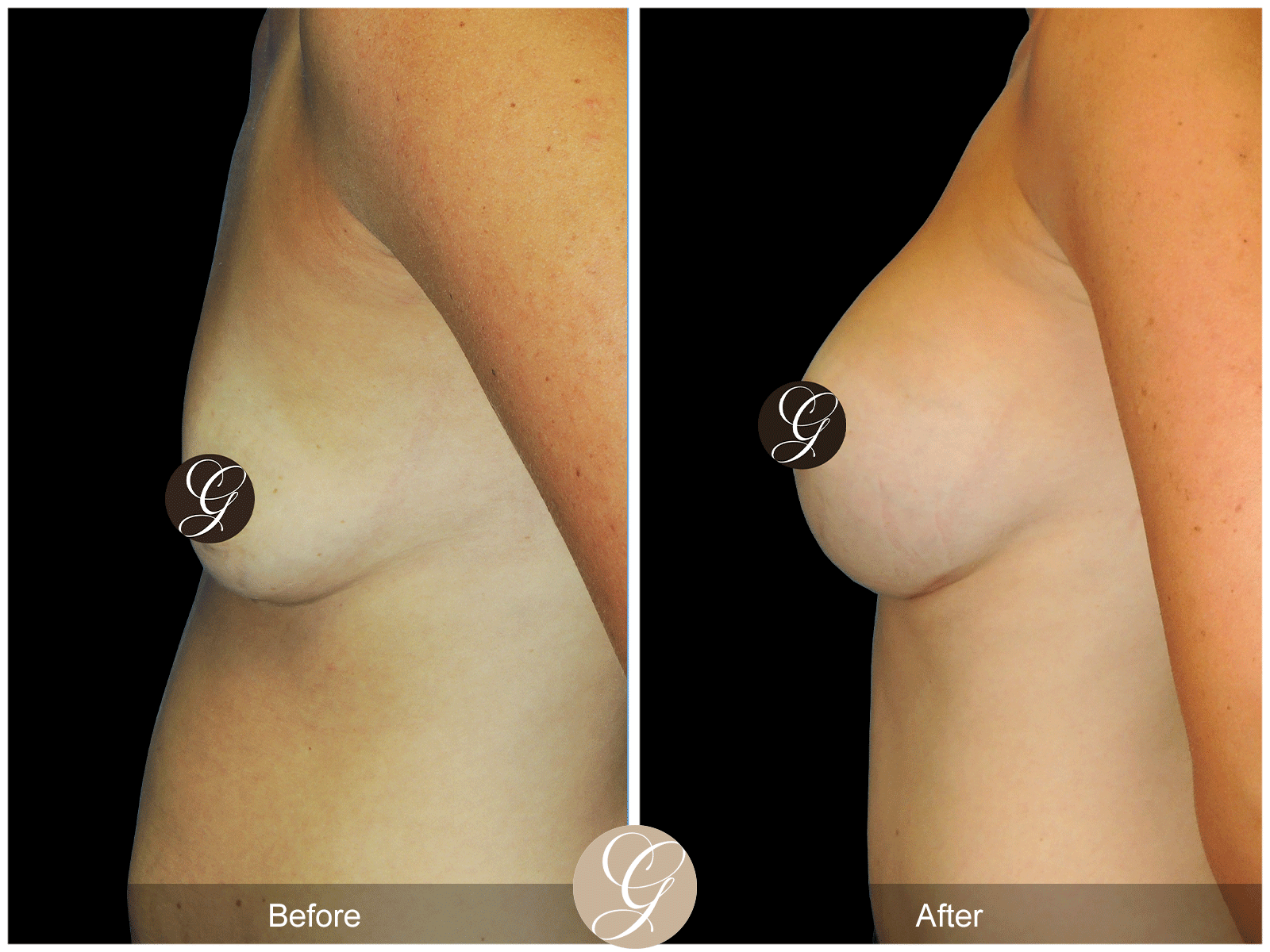 Breast Augmentation Pt 25 Image