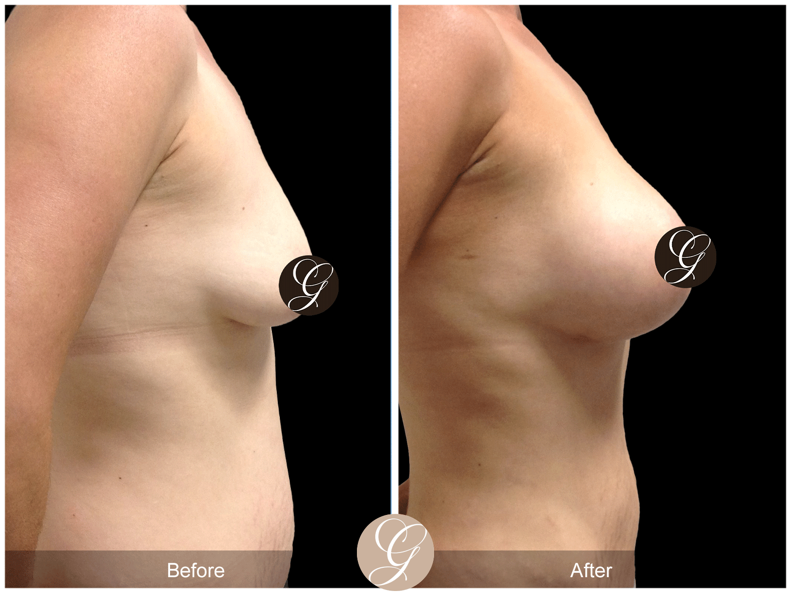 Breast Augmentation Pt 26 Image