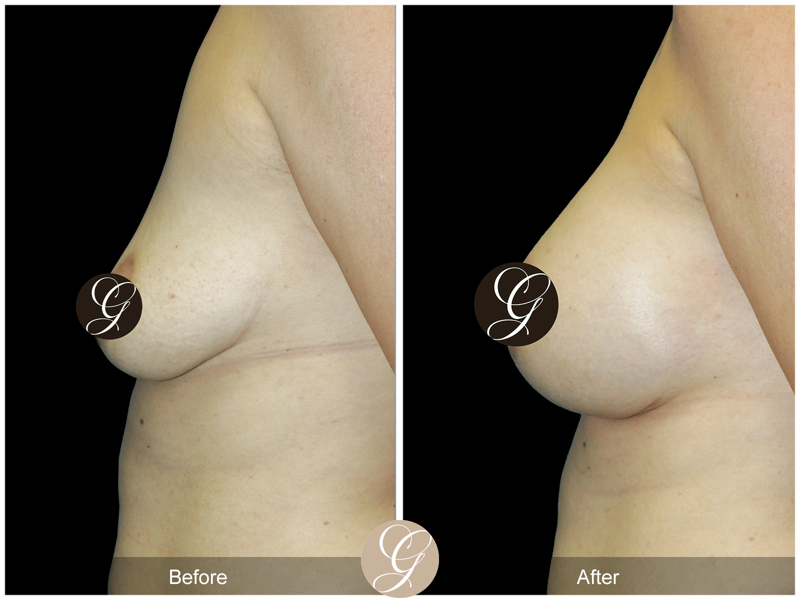Breast Augmentation Pt 27 Image