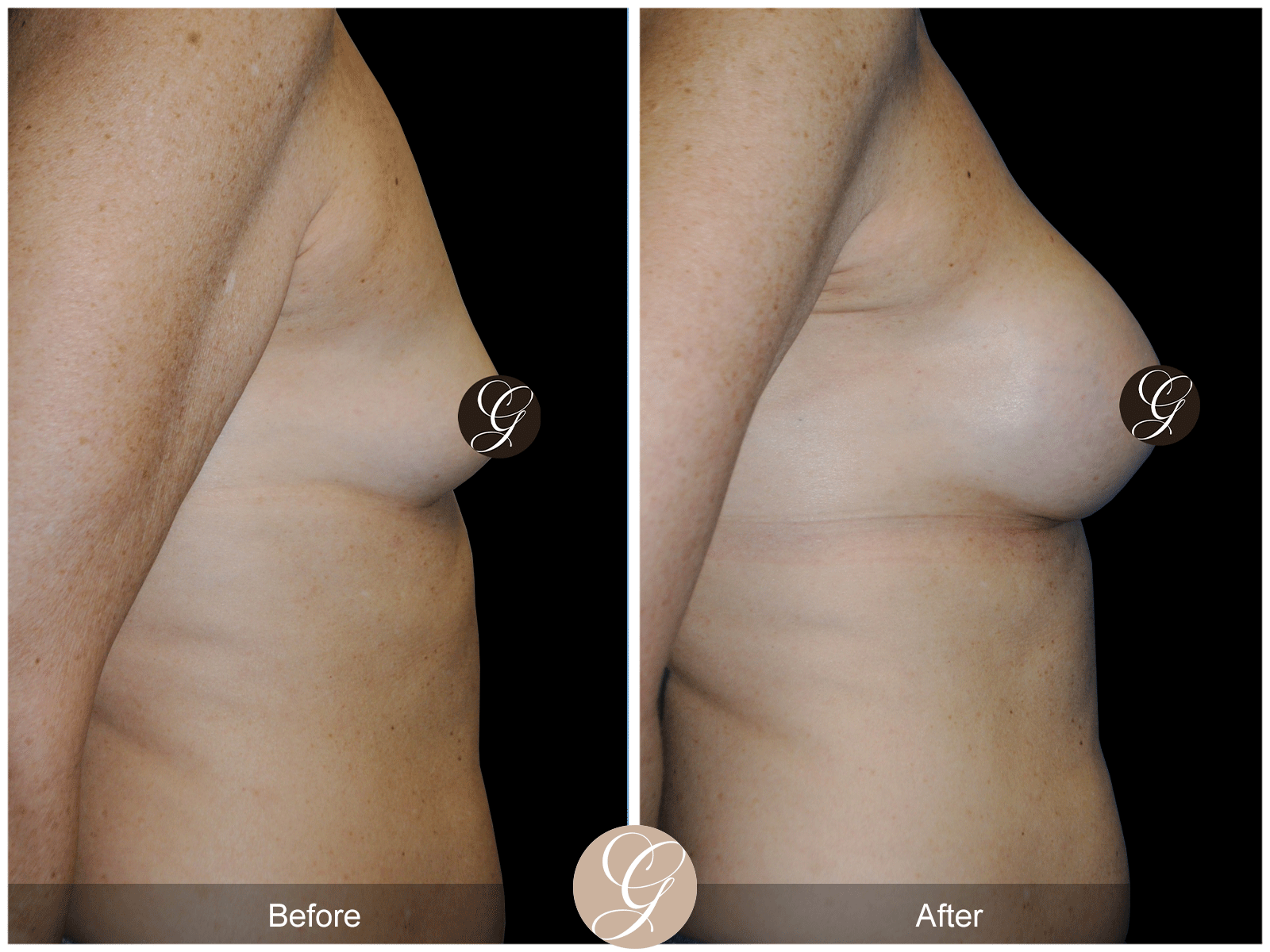 Breast Augmentation Pt 28 Image